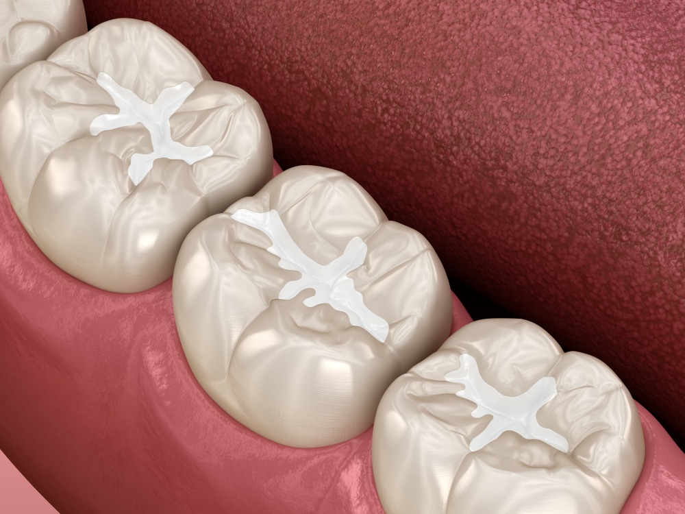 example of dental sealants in winnipeg