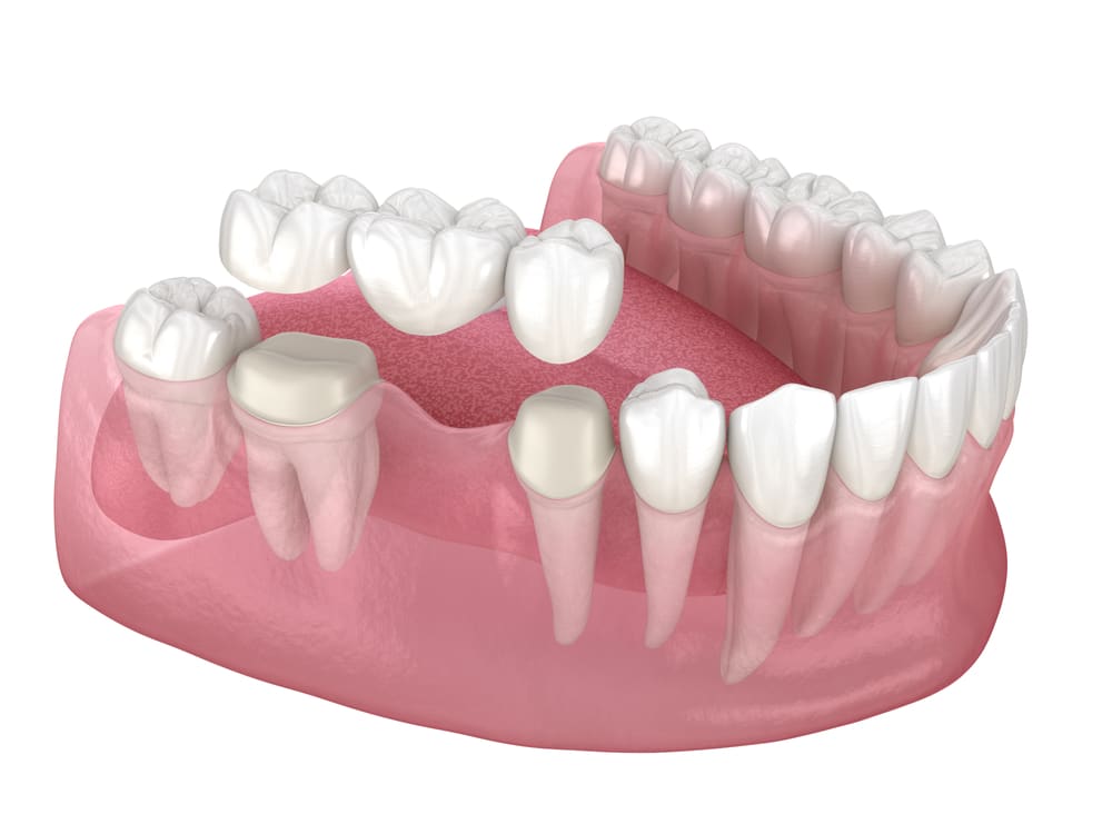 Dental Bridges in Winnipeg