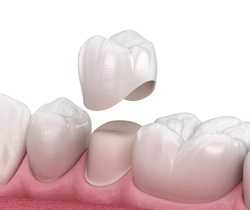 Dental Crowns in Winnipeg