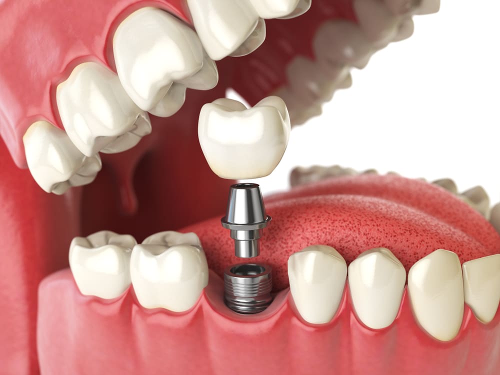 example of Dental Implants in Winnipeg
