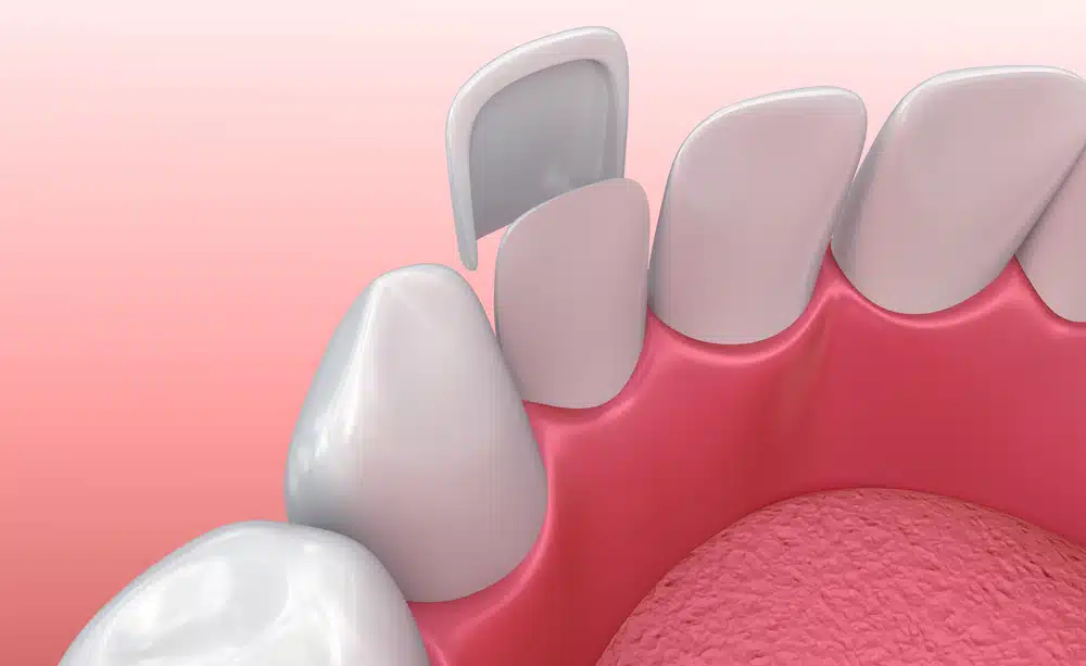 Enhance Your Smile & Confidence with veneers in Winnipeg
