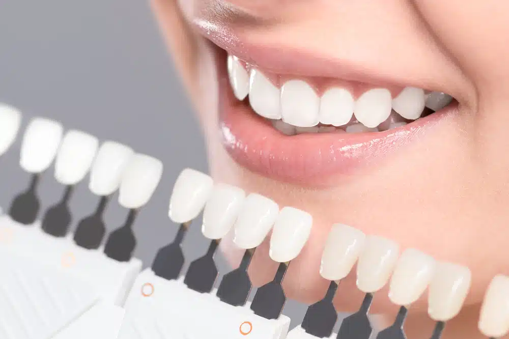 Winnipeg Teeth Whitening
