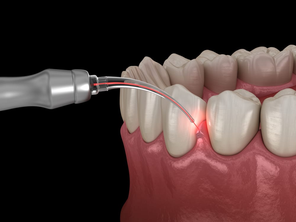 Laser Gum Treatment in Winnipeg