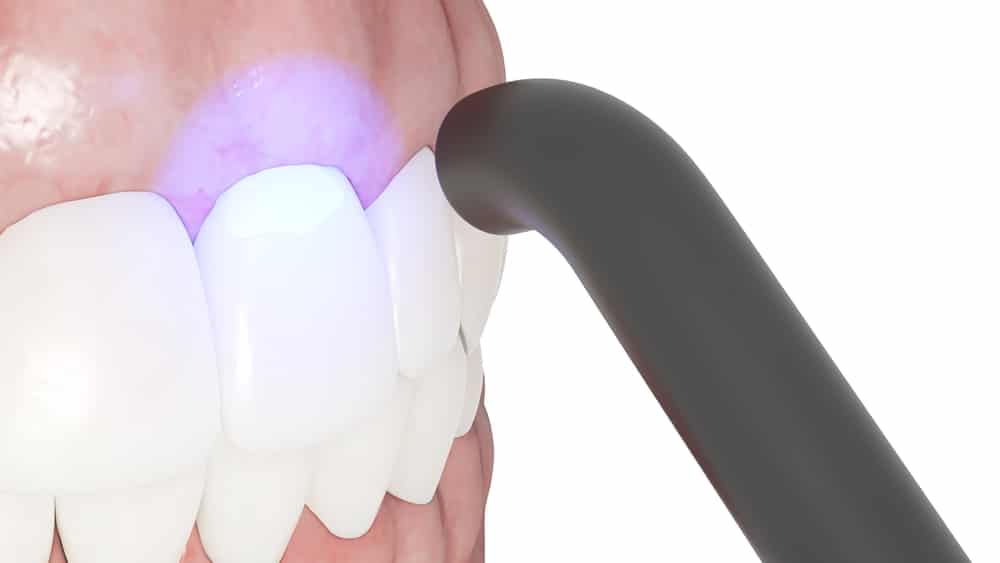 Dental Bonding in Winnipeg