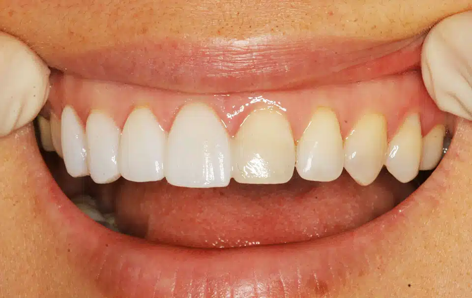 Dental veneers or Lumineers placed on front teeth for cosmetic smile enhancement