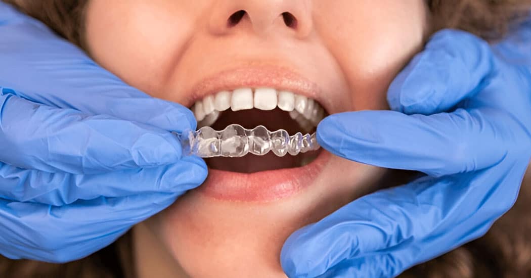 Dental professional placing clear Invisalign aligners onto a person’s upper teeth during orthodontic treatment.