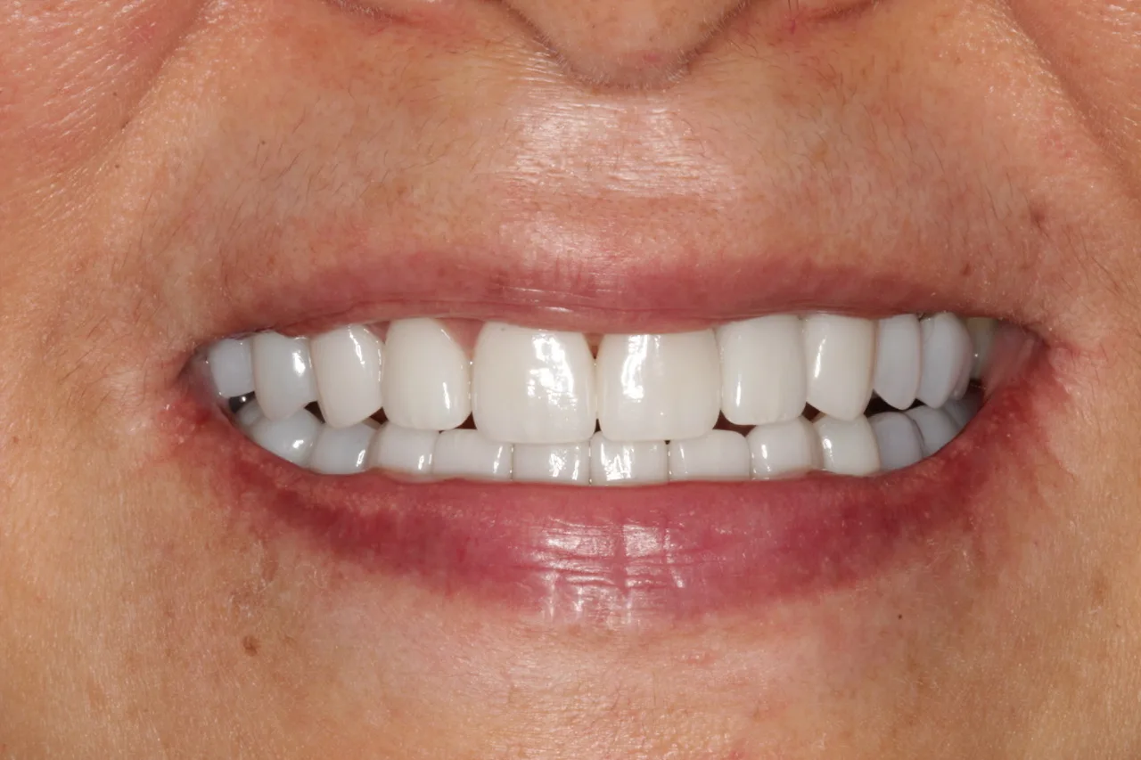 teeth whitening before and after
