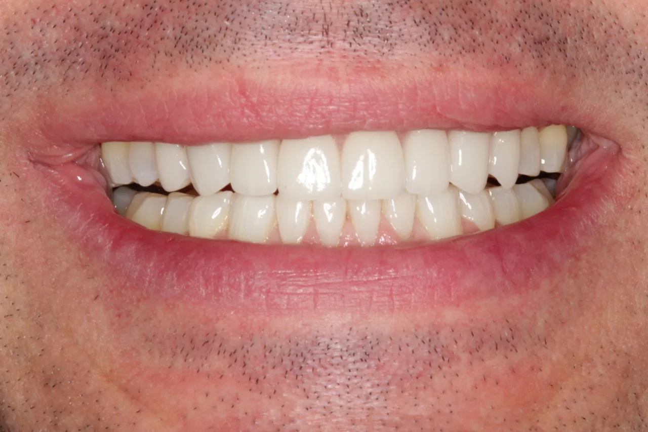 After teeth whitening in Winnipeg 2