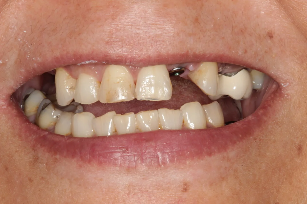Before Teeth Whitening Winnipeg