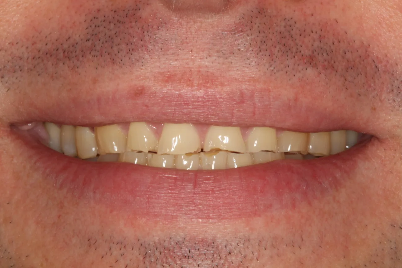 before teeth whitening in winnipeg 2